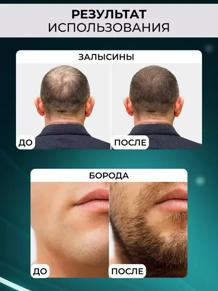 Мезороллер и сыворотка